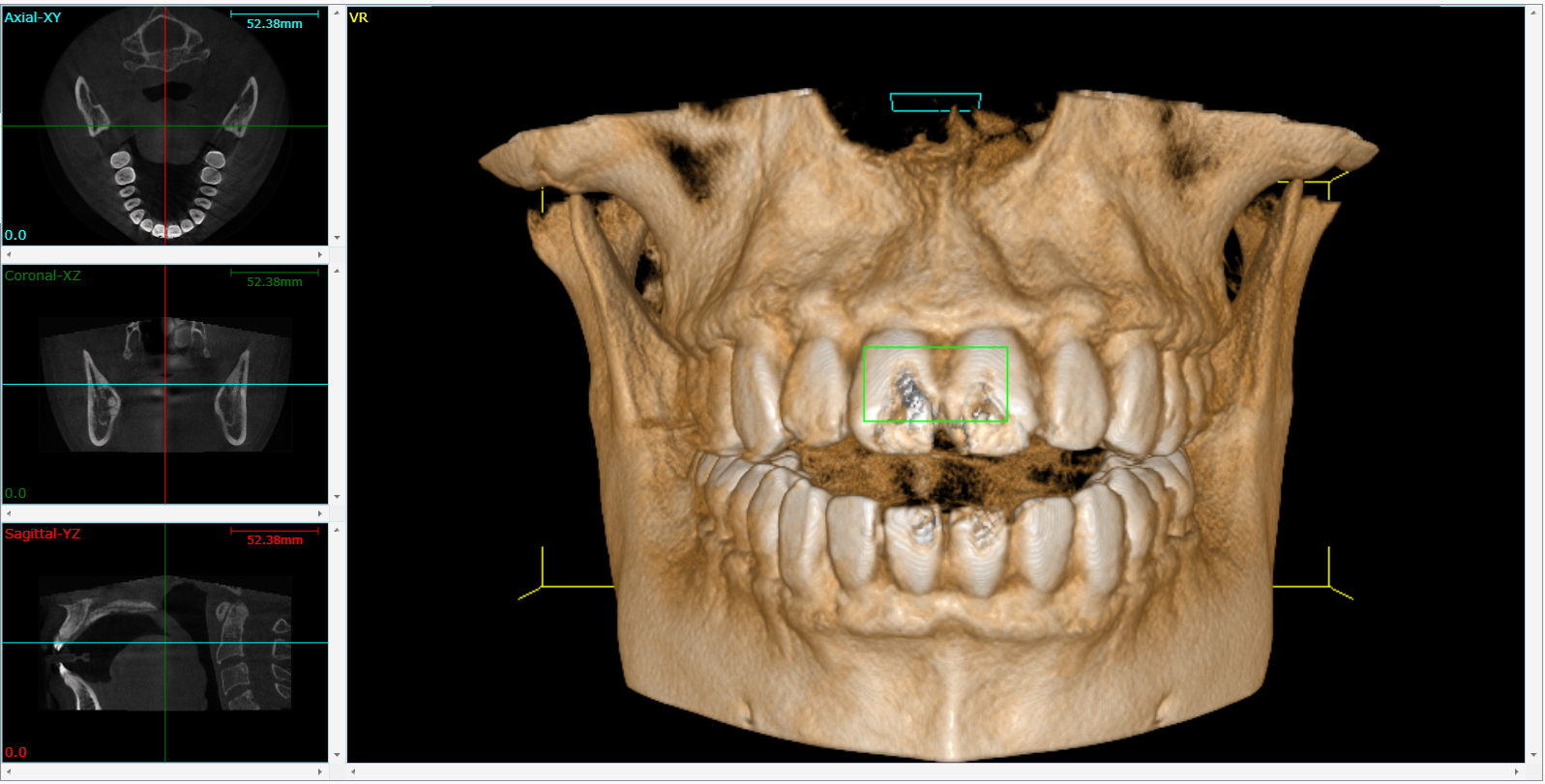 Cone Beam 3D Imaging  Albany, NY, 